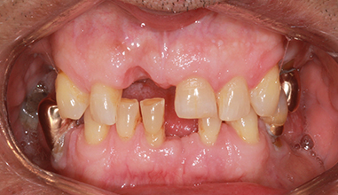 Before - Natural Smiles Implant & Cosmetic Dentistry