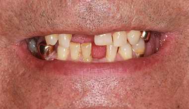 Before - Natural Smiles Implant & Cosmetic Dentistry