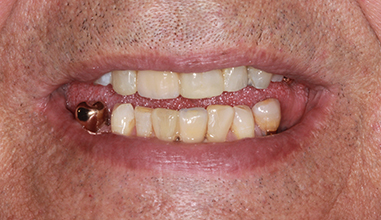 After - Natural Smiles Implant & Cosmetic Dentistry