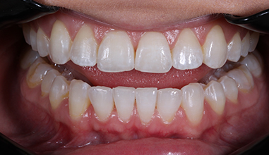 Before - Natural Smiles Implant & Cosmetic Dentistry