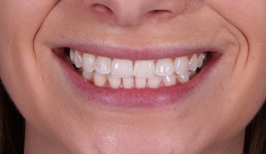 Before - Natural Smiles Implant & Cosmetic Dentistry