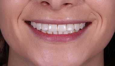 After - Natural Smiles Implant & Cosmetic Dentistry