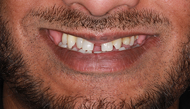 Before - Natural Smiles Implant & Cosmetic Dentistry