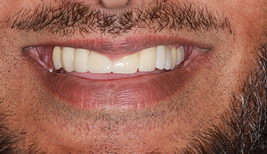 After - Natural Smiles Implant & Cosmetic Dentistry