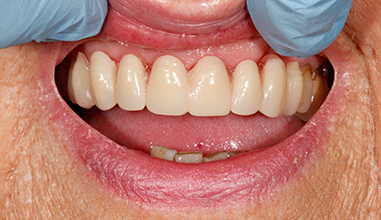 After - Natural Smiles Implant & Cosmetic Dentistry