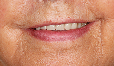 Before - Natural Smiles Implant & Cosmetic Dentistry