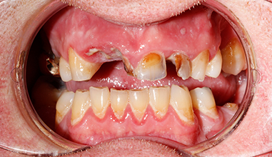 Before - Natural Smiles Implant & Cosmetic Dentistry