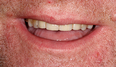 After - Natural Smiles Implant & Cosmetic Dentistry