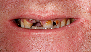 Before - Natural Smiles Implant & Cosmetic Dentistry