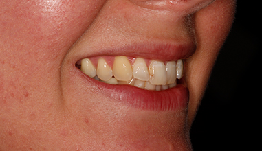 Before - Natural Smiles Implant & Cosmetic Dentistry