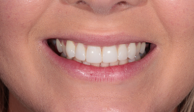 After - Natural Smiles Implant & Cosmetic Dentistry