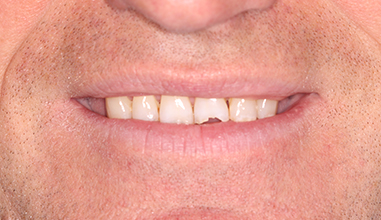 Before - Natural Smiles Implant & Cosmetic Dentistry