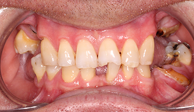 Before - Natural Smiles Implant & Cosmetic Dentistry