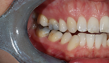 Before - Natural Smiles Implant & Cosmetic Dentistry
