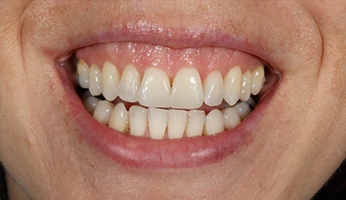 After - Natural Smiles Implant & Cosmetic Dentistry