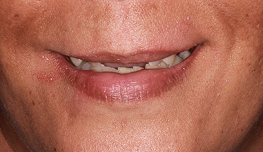 Before - Natural Smiles Implant & Cosmetic Dentistry