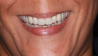 After - Natural Smiles Implant & Cosmetic Dentistry
