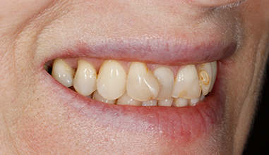 Before - Natural Smiles Implant & Cosmetic Dentistry