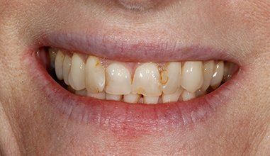 Before - Natural Smiles Implant & Cosmetic Dentistry