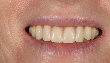 After - Natural Smiles Implant & Cosmetic Dentistry
