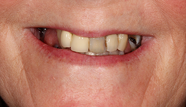 Before - Natural Smiles Implant & Cosmetic Dentistry