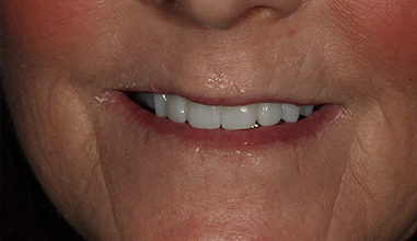 After - Natural Smiles Implant & Cosmetic Dentistry