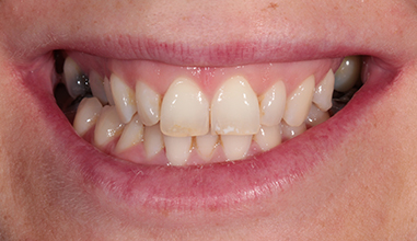 Before - Natural Smiles Implant & Cosmetic Dentistry