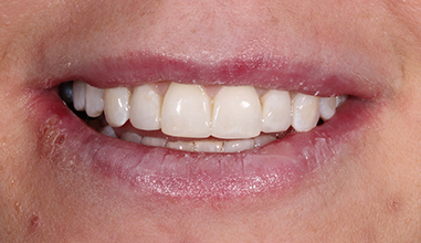 After - Natural Smiles Implant & Cosmetic Dentistry