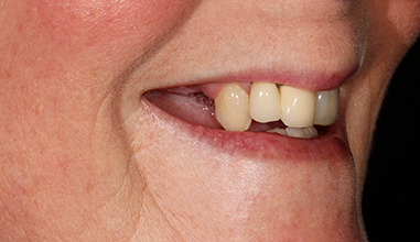 Before - Natural Smiles Implant & Cosmetic Dentistry