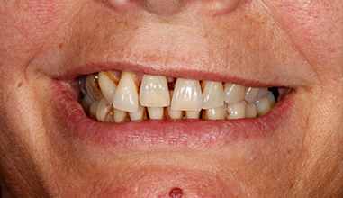 Before - Natural Smiles Implant & Cosmetic Dentistry