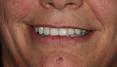 After - Natural Smiles Implant & Cosmetic Dentistry