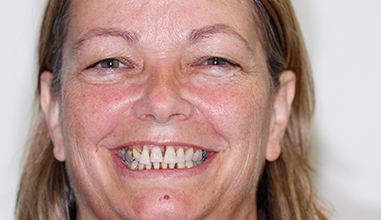 Before - Natural Smiles Implant & Cosmetic Dentistry