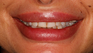 Before - Natural Smiles Implant & Cosmetic Dentistry