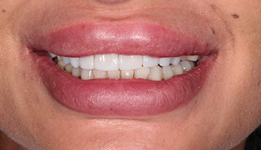 After - Natural Smiles Implant & Cosmetic Dentistry