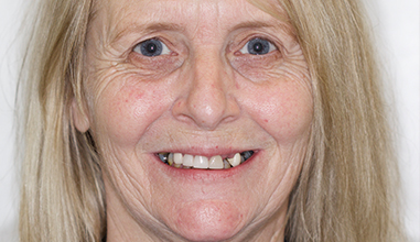 Before - Natural Smiles Implant & Cosmetic Dentistry