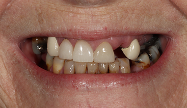 Before - Natural Smiles Implant & Cosmetic Dentistry