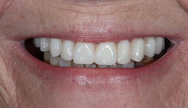 After - Natural Smiles Implant & Cosmetic Dentistry