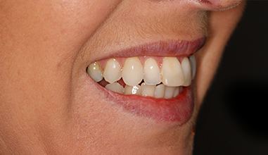 Before - Natural Smiles Implant & Cosmetic Dentistry