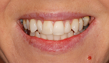 Before - Natural Smiles Implant & Cosmetic Dentistry