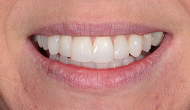 After - Natural Smiles Implant & Cosmetic Dentistry