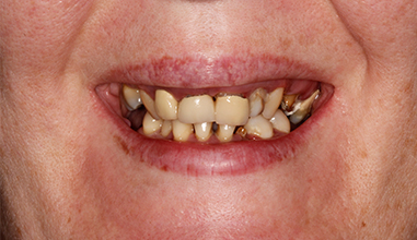 Before - Natural Smiles Implant & Cosmetic Dentistry