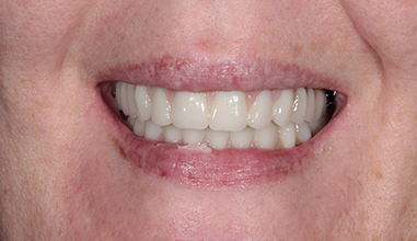 After - Natural Smiles Implant & Cosmetic Dentistry
