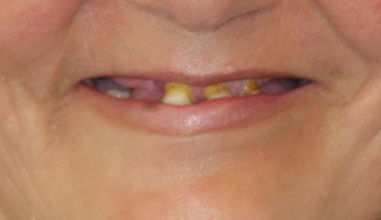 Before - Natural Smiles Implant & Cosmetic Dentistry