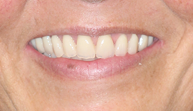 After - Natural Smiles Implant & Cosmetic Dentistry