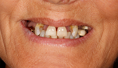 Before - Natural Smiles Implant & Cosmetic Dentistry