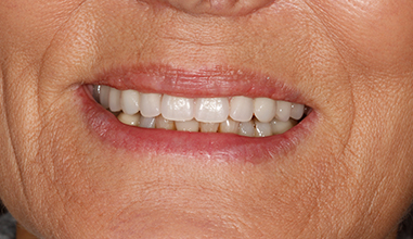 After - Natural Smiles Implant & Cosmetic Dentistry