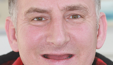 Before - Natural Smiles Implant & Cosmetic Dentistry