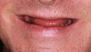 Before - Natural Smiles Implant & Cosmetic Dentistry