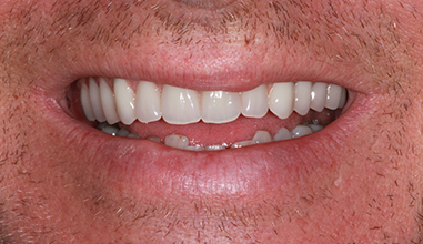 After - Natural Smiles Implant & Cosmetic Dentistry