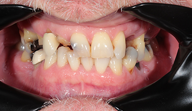 Before - Natural Smiles Implant & Cosmetic Dentistry